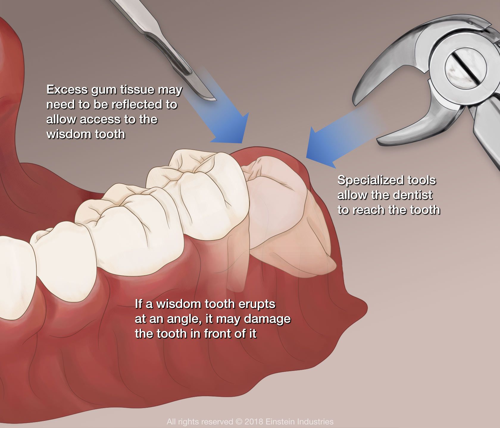 An illustration of an impacted wisdom tooth being removed
