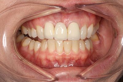 patient before full mouth reconstruction