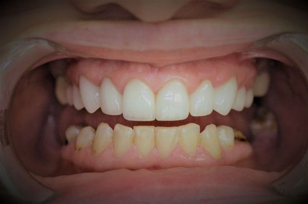 After porcelain crowns