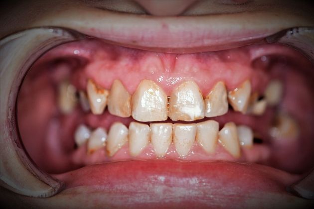 Before porcelain crowns